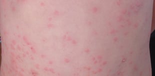 Gwent measles outbreak is over 