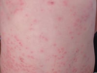 Two measles cases confirmed in Gwent says PHW