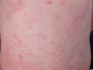 Gwent measles outbreak is over 