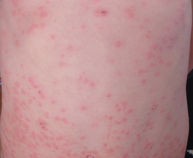 Measles 'outbreak' declared in Gwent as more cases confirmed