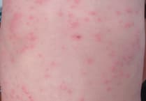Two measles cases confirmed in Gwent