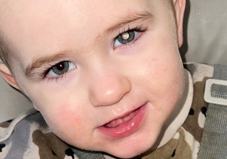 Koopers left eye with the glow.  A toddler was diagnosed with eye cancer after his parents noticed a white glow in his left eye.  Shane Stevenson, 35, and his partner, Lowri Gallagher, 30, were at home when they noticed a white glow in their then one-year-old son, Kooper's eye.  It was only noticeable in low-light conditions or when they took a photo of Kooper with the flash on.  An ultrasound revealed a lump in Kooper's eye, and he was referred to Birmingham Women and Childrens Hospital in December 2024.  He underwent an optical coherence tomography scan -  an advanced scan that allows opticians to assess your eye health -  before he was diagnosed with retinoblastoma - a rare eye cancer that typically affects children under the age of six.  In December 2024, Kooper started intra-arterial chemotherapy -  a targeted cancer treatment where chemotherapy drugs are delivered directly to the area - before having laser therapy and one round of chemotherapy injections.  The tot is still undergoing treatment, and Shane said the results have been "mixed".