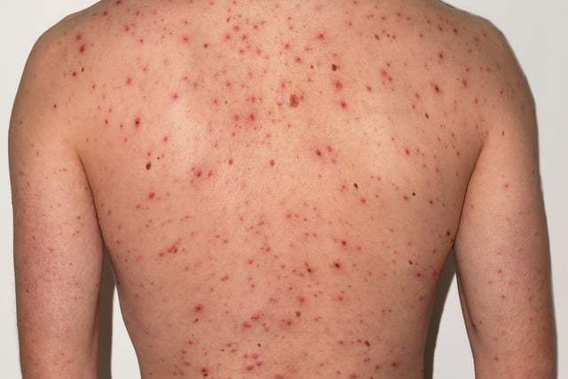 Wales begins chickenpox vaccine rollout
