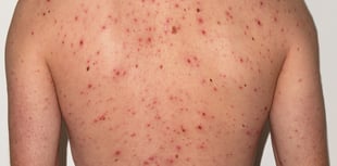 Wales begins chickenpox vaccine rollout